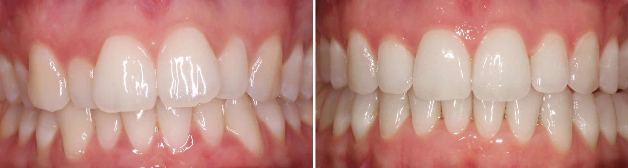 Invisalign Accredited Clinic Northern Beaches